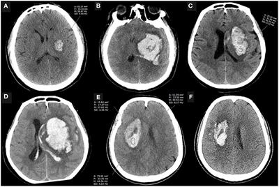 The Attenuation Value Within the Non-hypodense Region on Non-contrast Computed Tomography of Spontaneous Cerebral Hemorrhage: A Long-Neglected Predictor of Hematoma Expansion